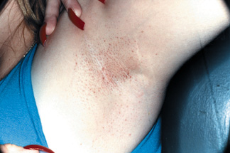 Axila com pelos encravados e foliculite antes do Tend Skin